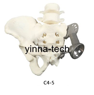 3D打印与医疗——外科金属植入物